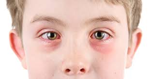 CONJUNTIVITIS